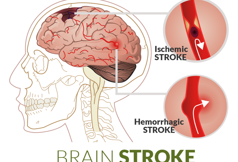 Illustration for article titled Obat Stroke Islami